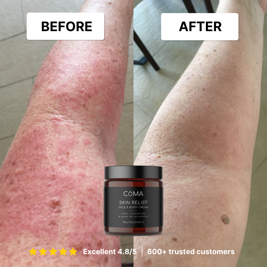 Before and after results of using skin relief lotion, showing significant skin improvement.